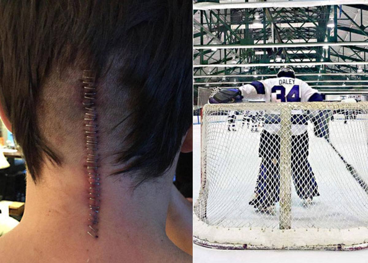 Daley-back-scar-Jack-Leslie.jpg